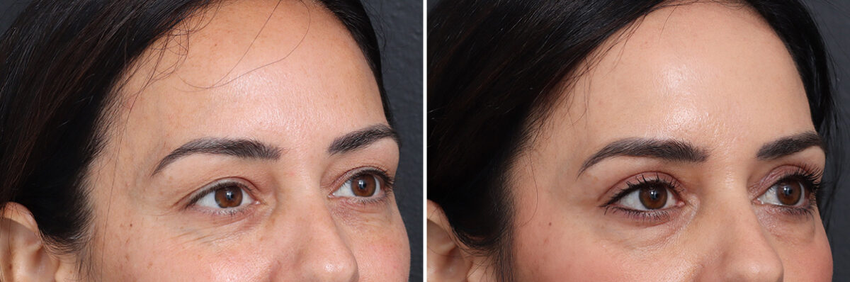 Upper Eyelid Surgery Before and After Photos in Princeton, NJ, Patient 21293