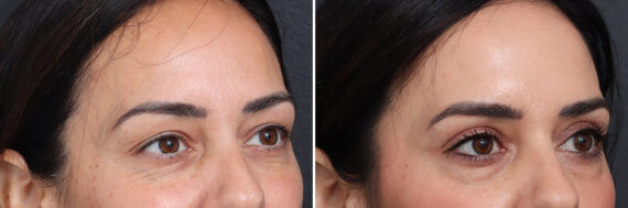 Upper Eyelid Surgery Before and After Photos in Princeton, NJ, Patient 21293
