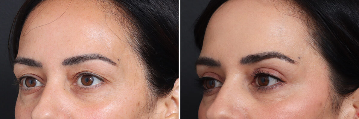 Upper Eyelid Surgery Before and After Photos in Princeton, NJ, Patient 21293