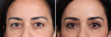 Upper Eyelid Surgery Before and After Photos in Princeton, NJ, Patient 21293