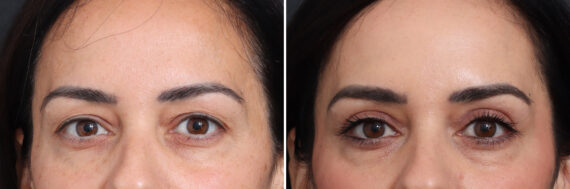 Upper Eyelid Surgery Before and After Photos in Princeton, NJ, Patient 21293