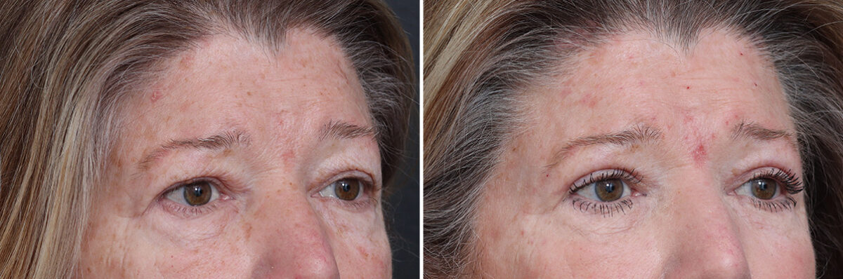 Upper Eyelid Surgery Before and After Photos in Princeton, NJ, Patient 21297