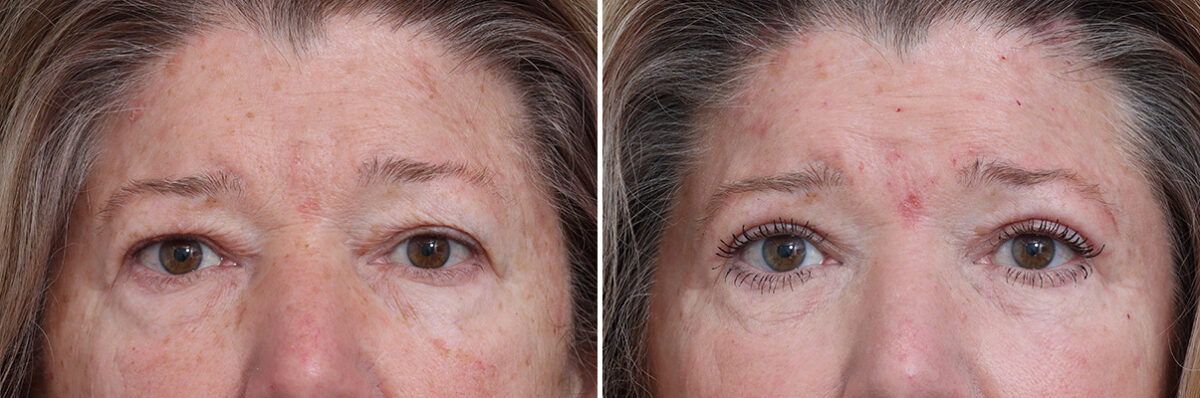 Upper Eyelid Surgery Before and After Photos in Princeton, NJ, Patient 21297