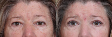 Upper Eyelid Surgery Before and After Photos in Princeton, NJ, Patient 21297