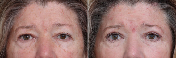 Upper Eyelid Surgery Before and After Photos in Princeton, NJ, Patient 21297