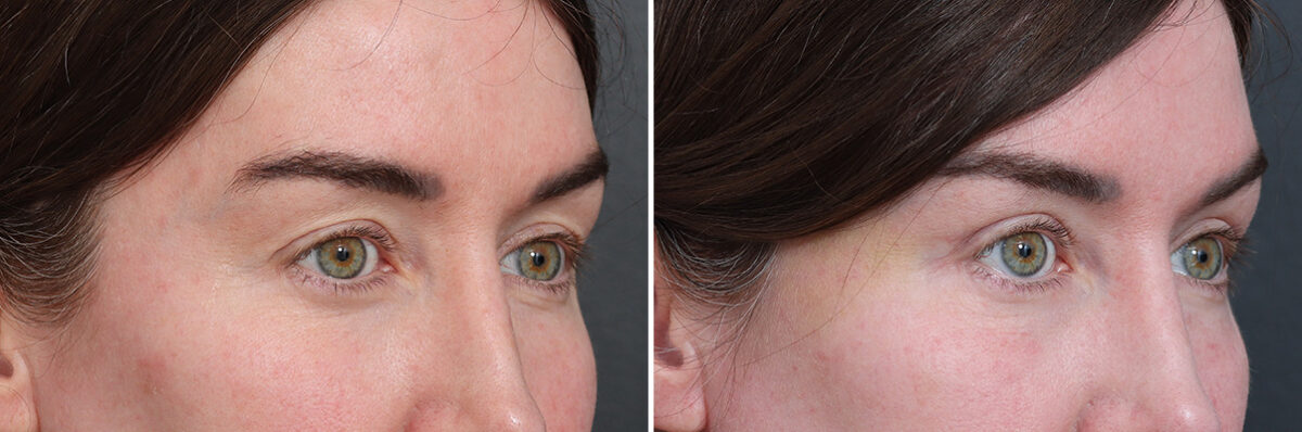 Upper Eyelid Surgery Before and After Photos in Princeton, NJ, Patient 21300