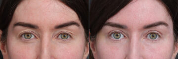 Upper Eyelid Surgery Before and After Photos in Princeton, NJ, Patient 21300