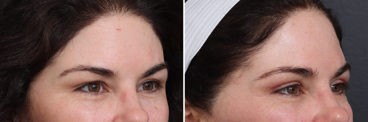 Upper Eyelid Surgery Before and After Photos in Princeton, NJ, Patient 21303