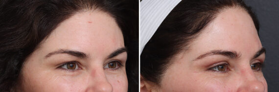 Upper Eyelid Surgery Before and After Photos in Princeton, NJ, Patient 21303
