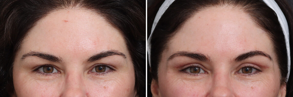 Upper Eyelid Surgery Before and After Photos in Princeton, NJ, Patient 21303