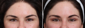 Upper Eyelid Surgery Before and After Photos in Princeton, NJ, Patient 21303