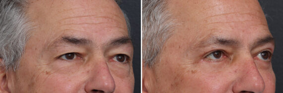 Upper and Lower Eyelid Surgery Before and After Photos in Princeton, NJ, Patient 21306