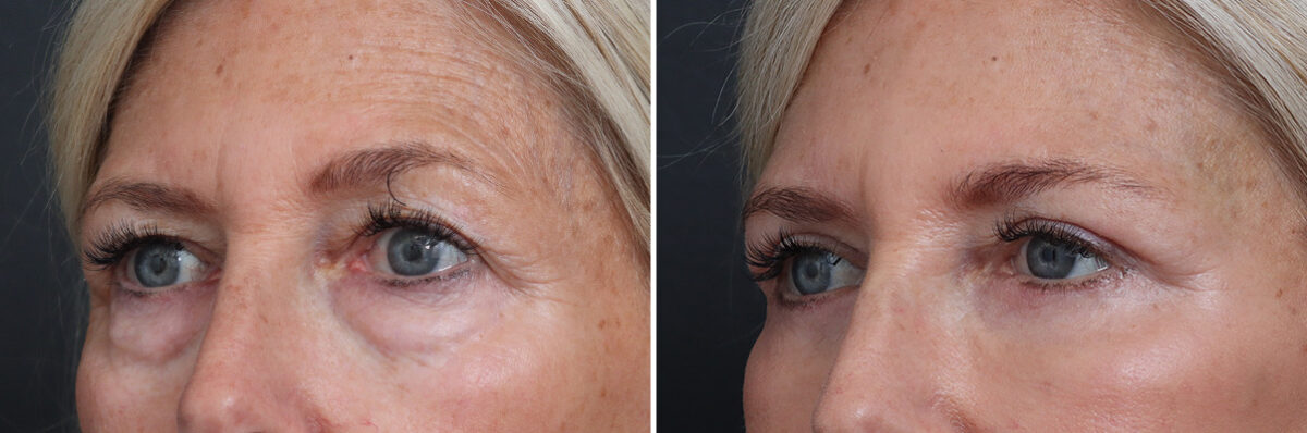 Upper and Lower Eyelid Surgery Before and After Photos in Princeton, NJ, Patient 21316