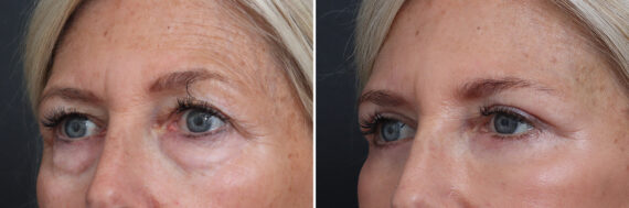 Upper and Lower Eyelid Surgery Before and After Photos in Princeton, NJ, Patient 21316