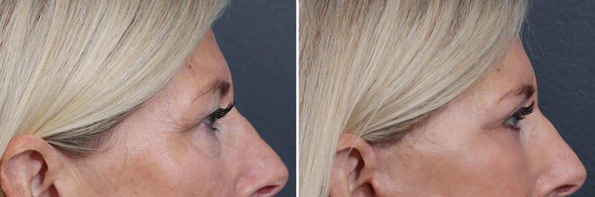 Upper and Lower Eyelid Surgery Before and After Photos in Princeton, NJ, Patient 21316