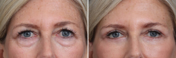 Upper and Lower Eyelid Surgery Before and After Photos in Princeton, NJ, Patient 21316