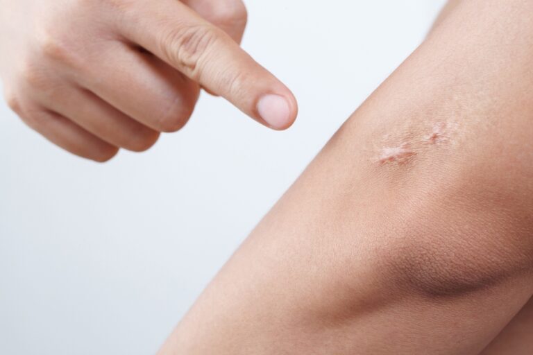 Healing arm incision during week one after surgery with visible early scar closure