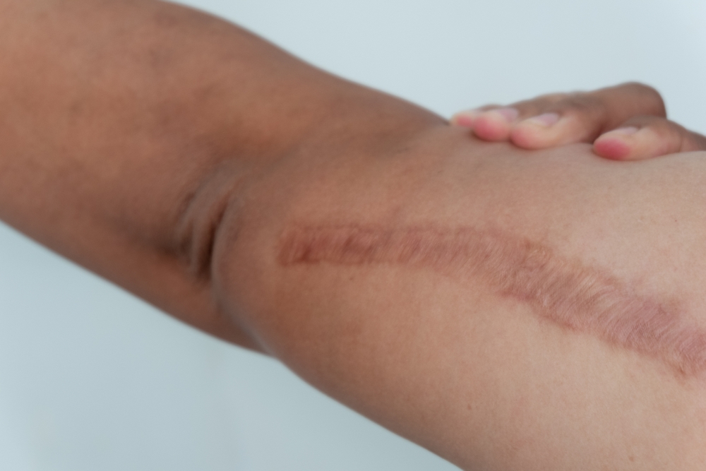 Arm incision showing early scar formation during weeks two through four of healing