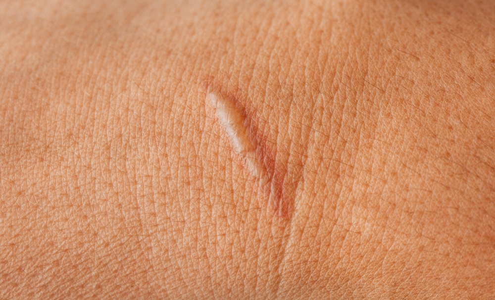 Close-up of healing scar during weeks five through eight as early remodeling begins