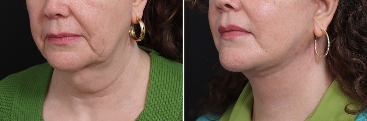 Facelift Before and After Photos in Princeton, NJ, Patient 21216