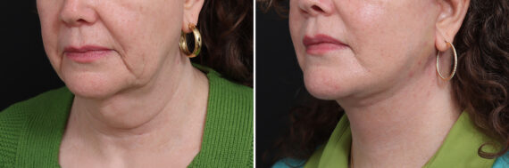 Facelift Before and After Photos in Princeton, NJ, Patient 21216