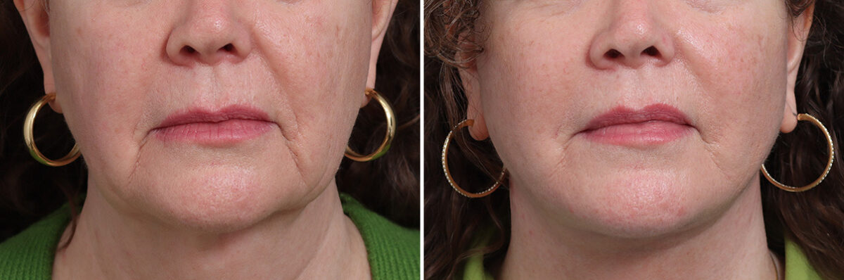Facelift Before and After Photos in Princeton, NJ, Patient 21216
