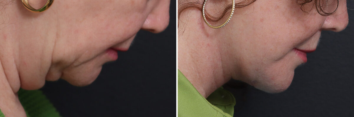 Facelift Before and After Photos in Princeton, NJ, Patient 21216