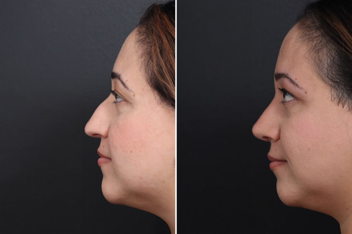 Rhinoplasty Before and After Photos in Princeton, NJ, Patient 21673