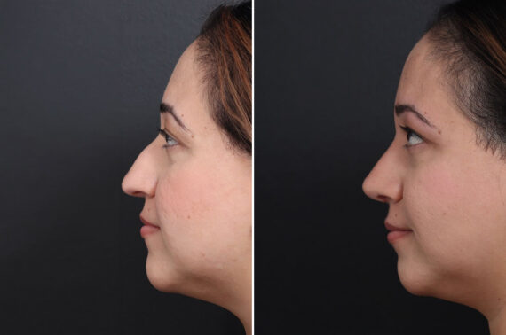 Rhinoplasty Before and After Photos in Princeton, NJ, Patient 21673
