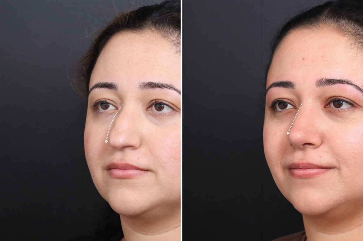 Rhinoplasty Before and After Photos in Princeton, NJ, Patient 21673