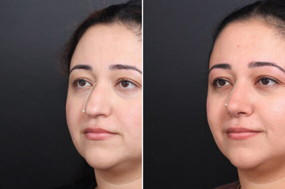 Rhinoplasty Before and After Photos in Princeton, NJ, Patient 21673