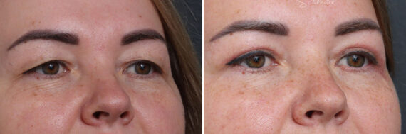 Upper Eyelid Surgery Before and After Photos in Princeton, NJ, Patient 21730