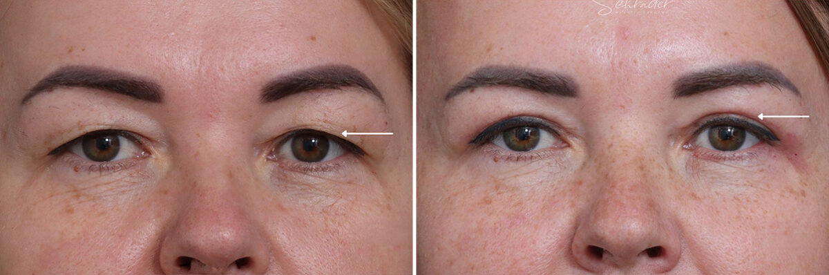 Upper Eyelid Surgery Before and After Photos in Princeton, NJ, Patient 21730