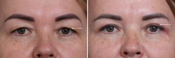 Upper Eyelid Surgery Before and After Photos in Princeton, NJ, Patient 21730