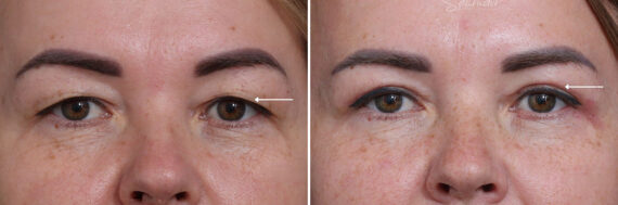 Upper Eyelid Surgery Before and After Photos in Princeton, NJ, Patient 21730