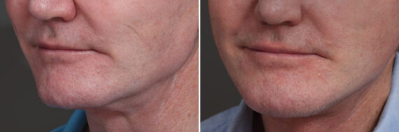 Chin Implants Before and After Photos in Princeton, NJ, Patient 21734