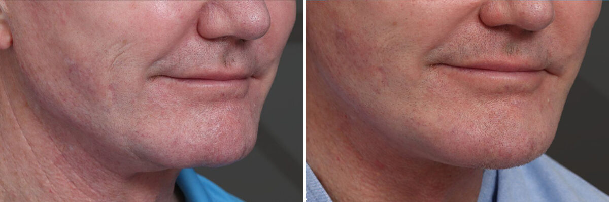 Chin Implants Before and After Photos in Princeton, NJ, Patient 21734