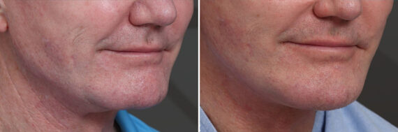 Chin Implants Before and After Photos in Princeton, NJ, Patient 21734