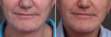 Chin Implants Before and After Photos in Princeton, NJ, Patient 21734
