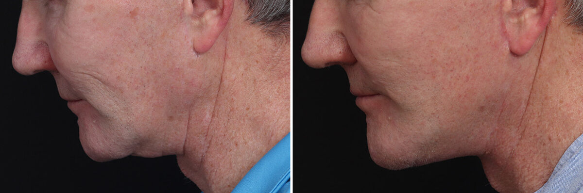 Chin Implants Before and After Photos in Princeton, NJ, Patient 21734