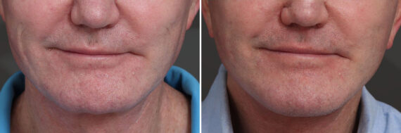 Chin Implants Before and After Photos in Princeton, NJ, Patient 21734