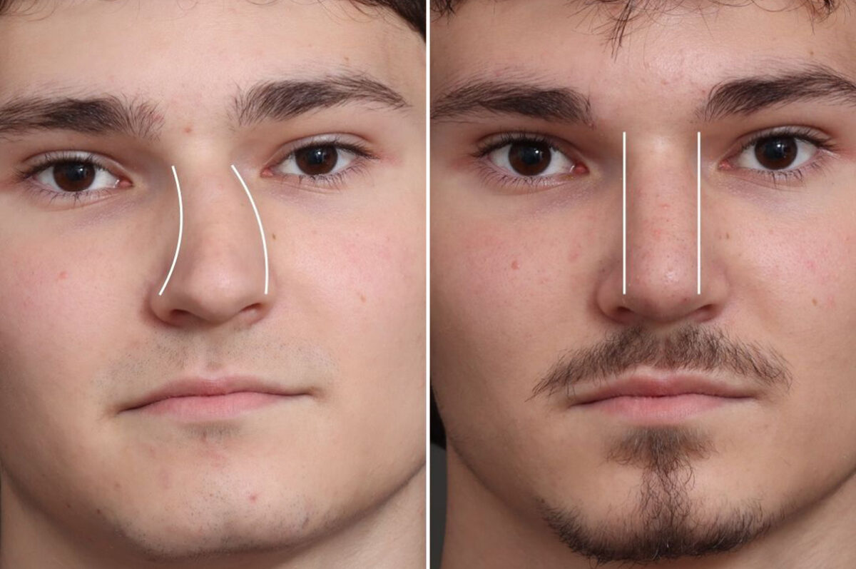 Rhinoplasty Before and After Photos in Princeton, NJ, Patient 21739