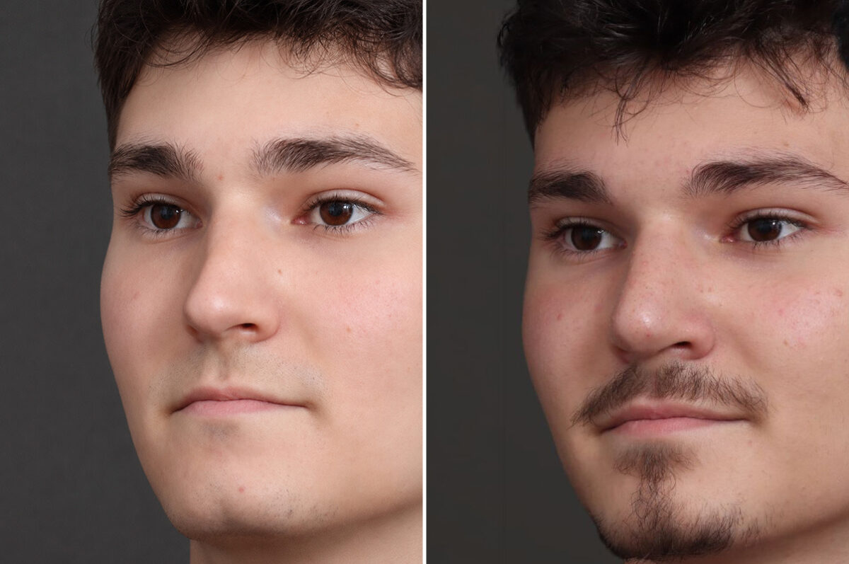 Rhinoplasty Before and After Photos in Princeton, NJ, Patient 21739