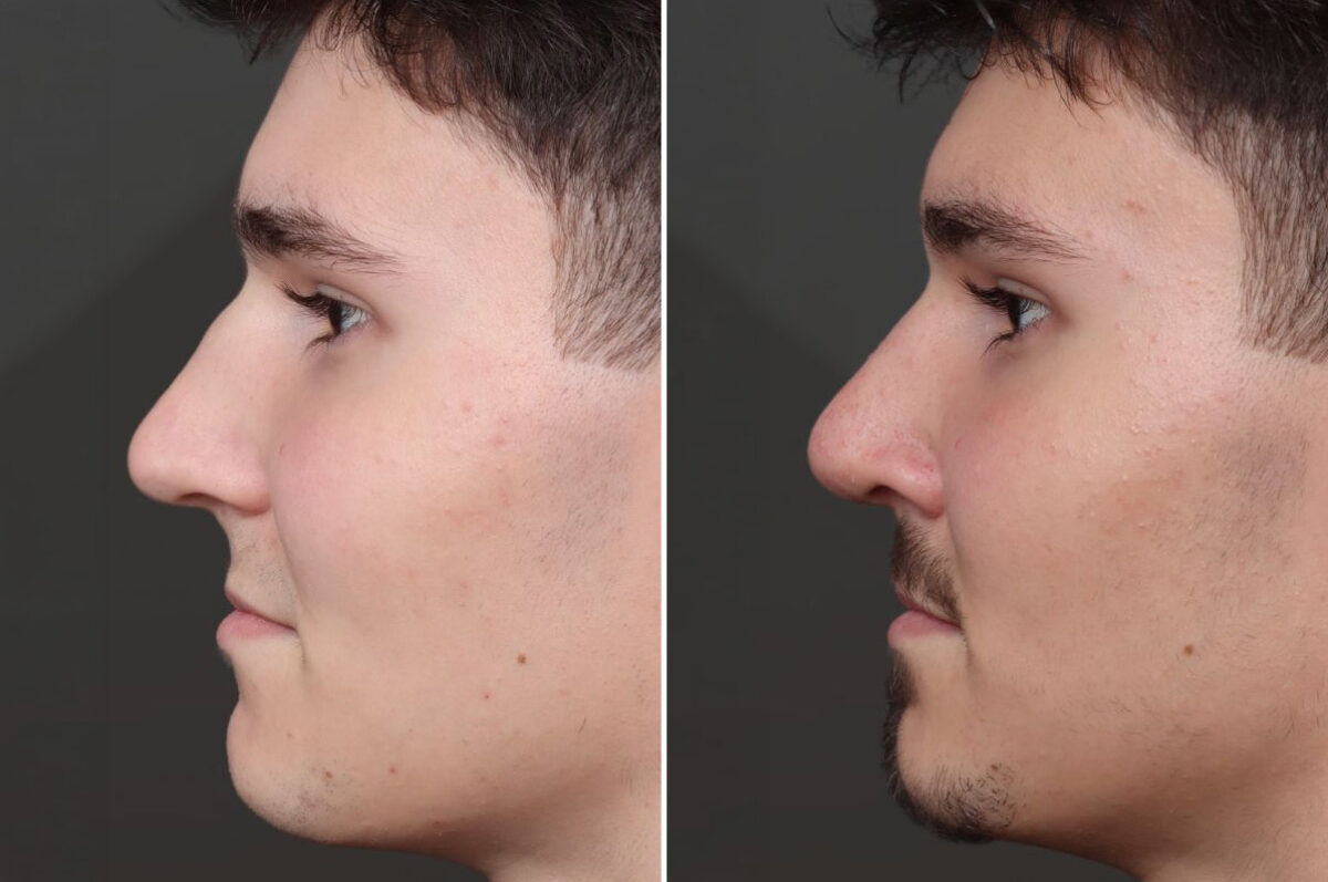 Rhinoplasty Before and After Photos in Princeton, NJ, Patient 21739