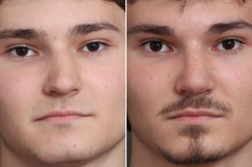 Rhinoplasty Before and After Photos in Princeton, NJ, Patient 21739