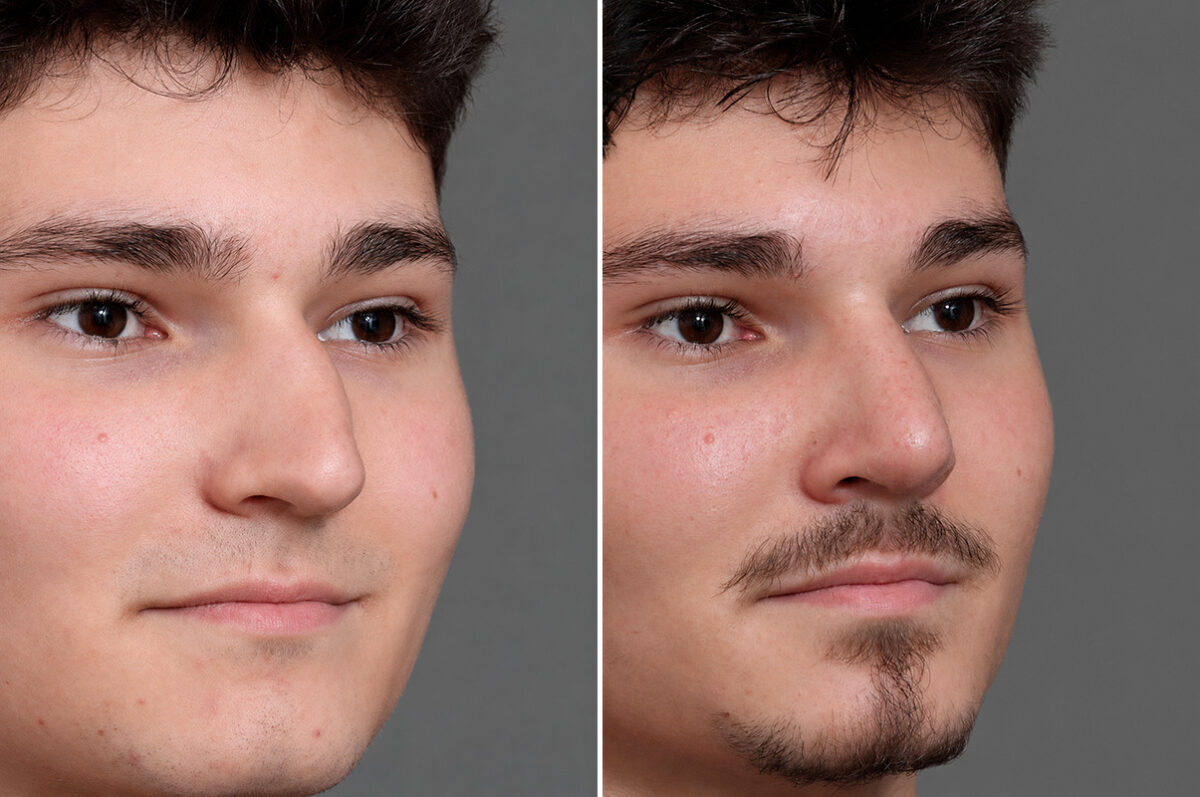 Rhinoplasty Before and After Photos in Princeton, NJ, Patient 21739