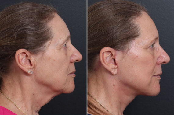 Facelift Before and After Photos in Princeton, NJ, Patient 21747