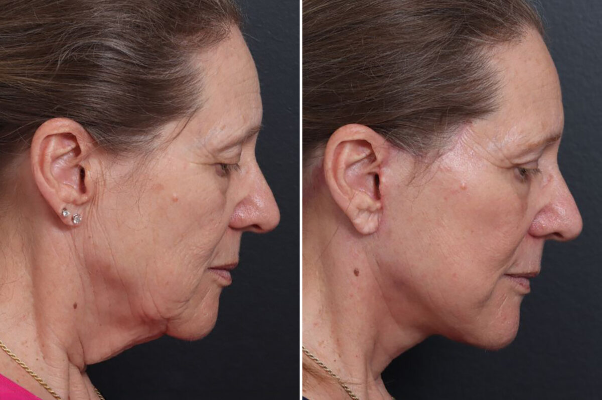 Facelift Before and After Photos in Princeton, NJ, Patient 21747
