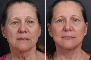 Facelift Before and After Photos in Princeton, NJ, Patient 21747