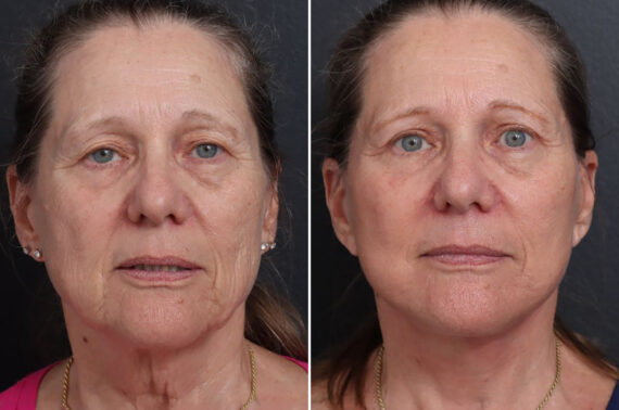 Facelift Before and After Photos in Princeton, NJ, Patient 21747